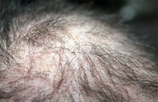 अगर इस तरह से झड़ रहे हैं बाल तो आप जल्द हो सकते हैं गंजे!