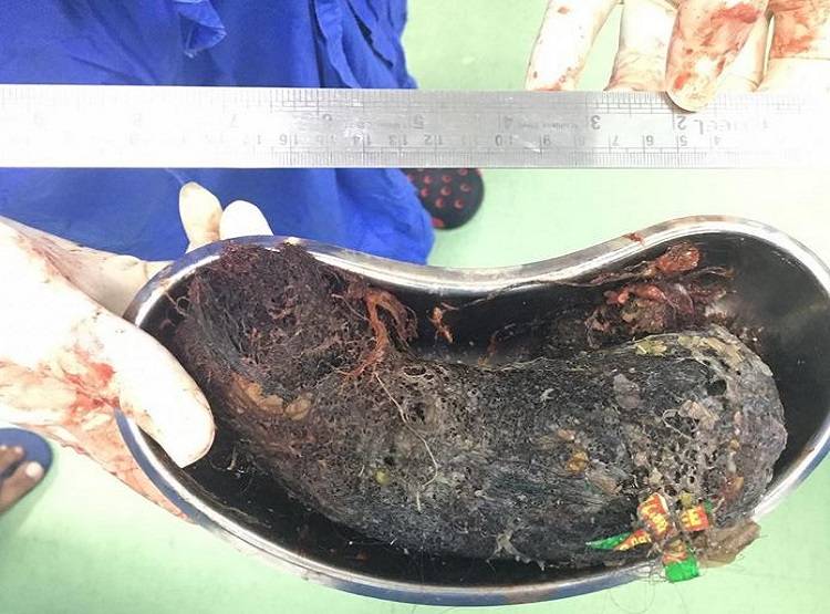 बच्ची के पेट से निकले आधा किलो बाल, शैंपू के पाउच, डॉक्टर भी हैरान