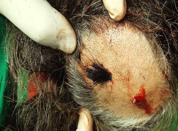 सिर-जबड़े में धंसीं थीं 4 गोलियां, कार चलाकर अस्पताल गई महिला, डॉक्टर भी हैरान