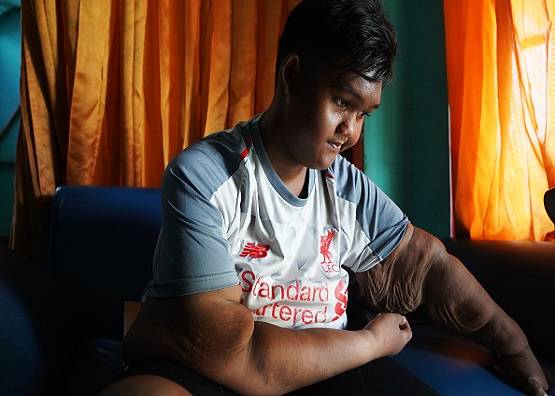 दुबला हो गया दुनिया का सबसे मोटा बच्चा, अपनाई ये तरकीब