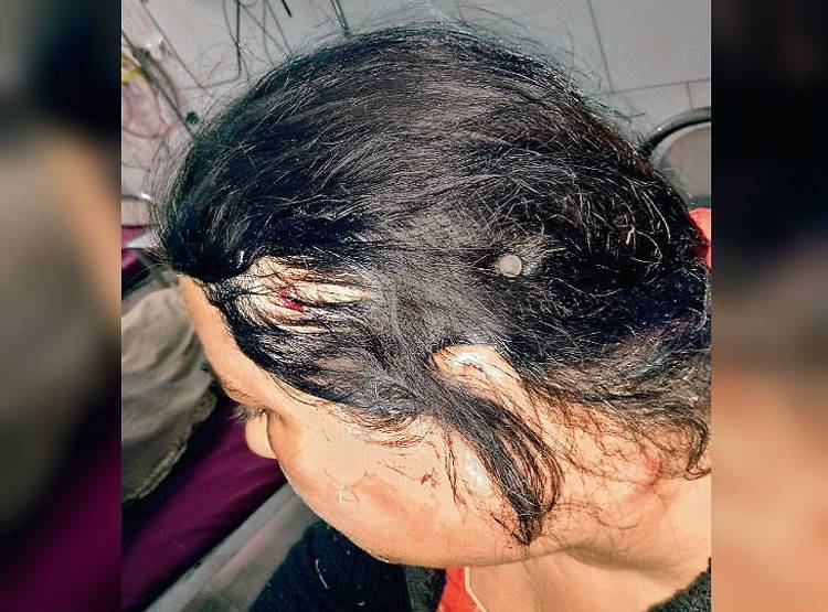 सिर-जबड़े में धंसीं थीं 4 गोलियां, कार चलाकर अस्पताल गई महिला, डॉक्टर भी हैरान