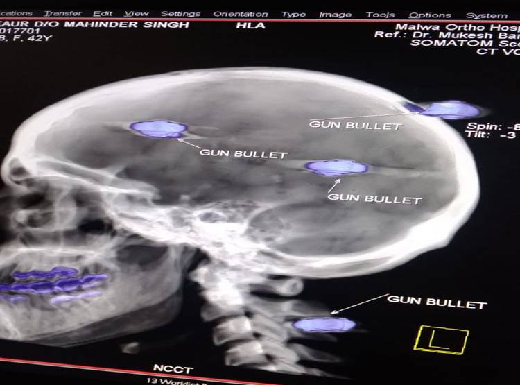 सिर-जबड़े में धंसीं थीं 4 गोलियां, कार चलाकर अस्पताल गई महिला, डॉक्टर भी हैरान
