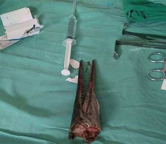 लड़के की गर्दन के आर-पार हो गई मछली, दिल दहलाने वाली फोटोज