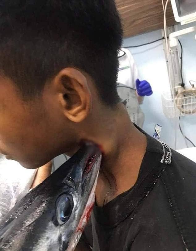 लड़के की गर्दन के आर-पार हो गई मछली, दिल दहलाने वाली फोटोज