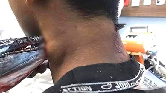 लड़के की गर्दन के आर-पार हो गई मछली, दिल दहलाने वाली फोटोज