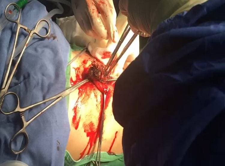 बच्ची के पेट से निकले आधा किलो बाल, शैंपू के पाउच, डॉक्टर भी हैरान