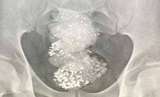 पेट के अंदर था 64 लाख का हीरा, एयरपोर्ट पर ऐसे खुला राज