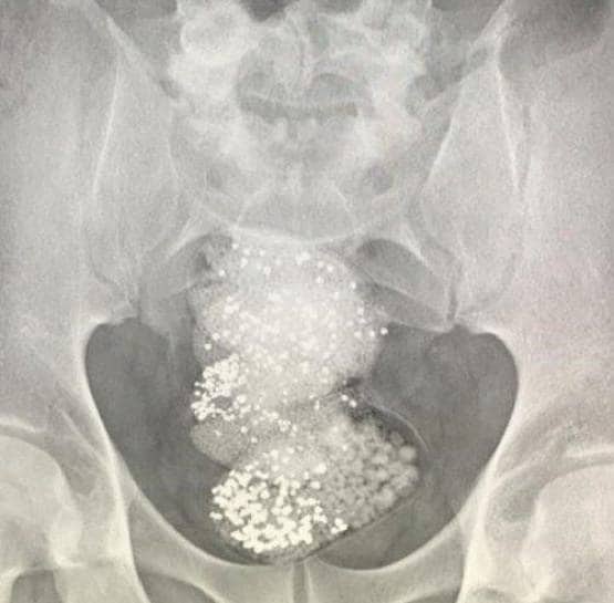 पेट के अंदर था 64 लाख का हीरा, एयरपोर्ट पर ऐसे खुला राज