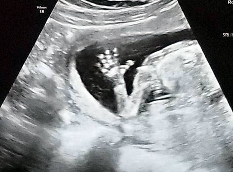 2 योनी-2 गर्भाशय...रेयर कंडिशन में इस महिला ने दिया बच्ची को जन्म