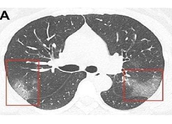 कोरोना अटैक के बाद ऐसे हो जाते हैं फेफड़े, सामने आई चौंकाने वाली तस्वीर