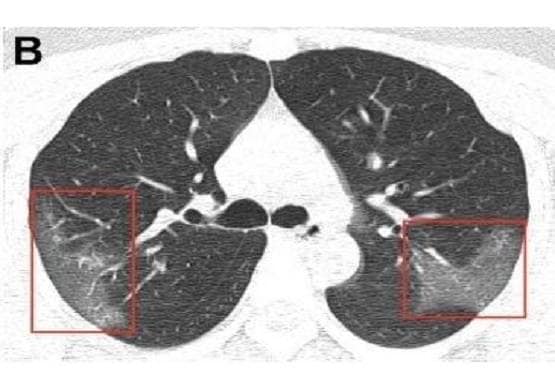 कोरोना अटैक के बाद ऐसे हो जाते हैं फेफड़े, सामने आई चौंकाने वाली तस्वीर