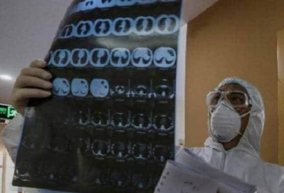 कोरोना अटैक के बाद ऐसे हो जाते हैं फेफड़े, सामने आई चौंकाने वाली तस्वीर