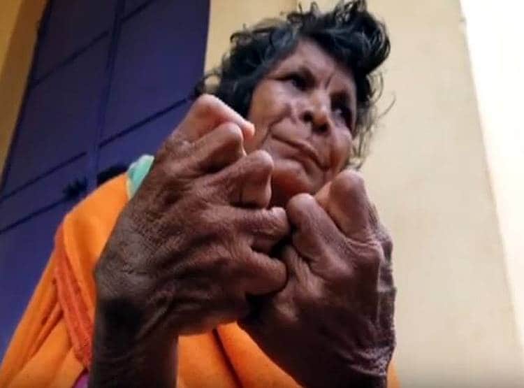 हाथ-पैर में 31 उंगलियां, लोग कहते थे चुड़ैल, गिनीज बुक में नाम दर्ज