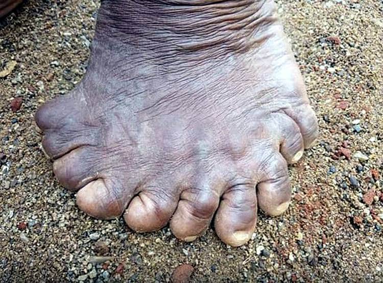 हाथ-पैर में 31 उंगलियां, लोग कहते थे चुड़ैल, गिनीज बुक में नाम दर्ज