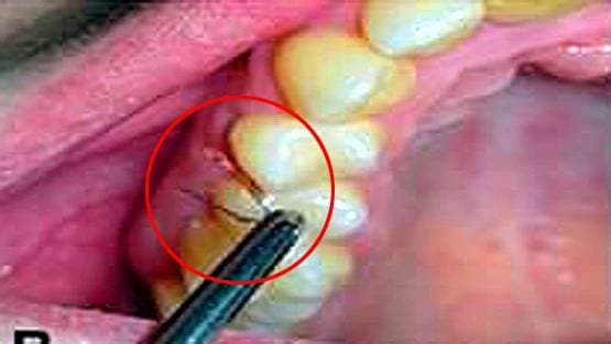 इस महिला के दांतों-मसूड़ों में उग रहे हैं बाल, डॉक्टर भी हैरान...