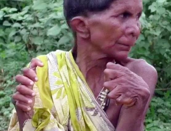 हाथ-पैर में 31 उंगलियां, लोग कहते थे चुड़ैल, गिनीज बुक में नाम दर्ज