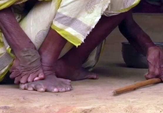 हाथ-पैर में 31 उंगलियां, लोग कहते थे चुड़ैल, गिनीज बुक में नाम दर्ज