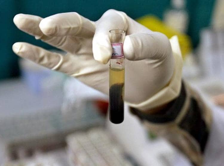 महिला का टेस्ट करते ही चौंके डॉक्टर, यूरीन की जगह बन रही शराब