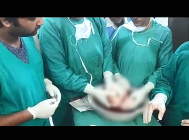 7 महीने के बच्चे के पेट से न‍िकला 8 महीने का भ्रूण, बन चुके थे हाथ-पैर