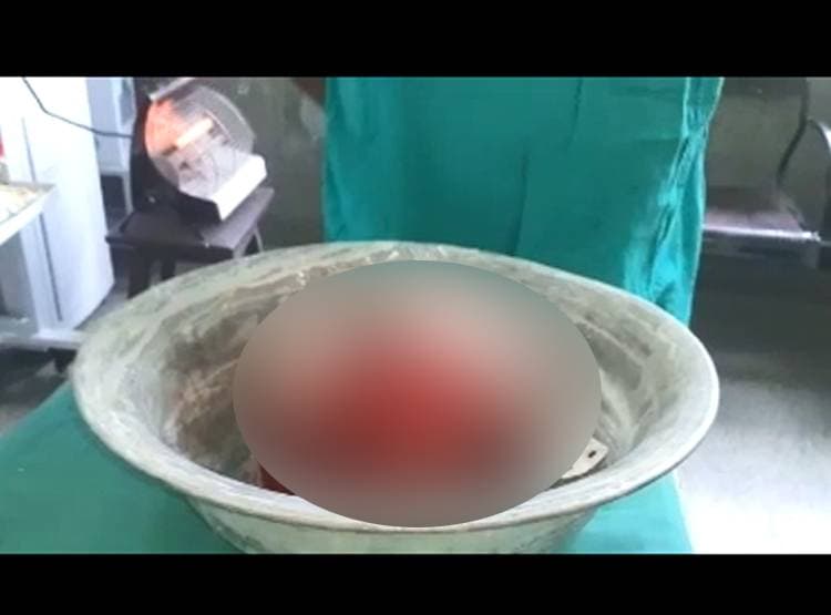 7 महीने के बच्चे के पेट से न‍िकला 8 महीने का भ्रूण, बन चुके थे हाथ-पैर