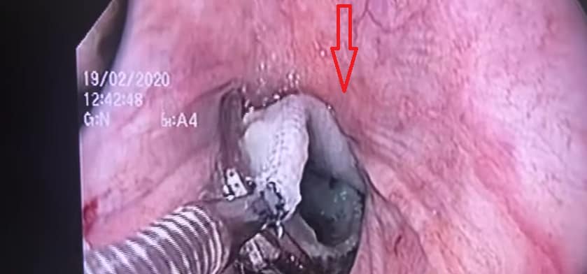 सांप ने निगल लिया बड़ा तौलिया तो डॉक्टरों ने ऐसे बचाई जान