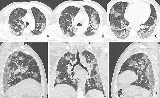 कोरोना वायरस से मरने वालों का क्या हुआ था हाल, देख लें ये रिपोर्ट्स