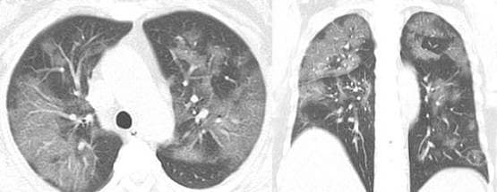 कोरोना वायरस से मरने वालों का क्या हुआ था हाल, देख लें ये रिपोर्ट्स