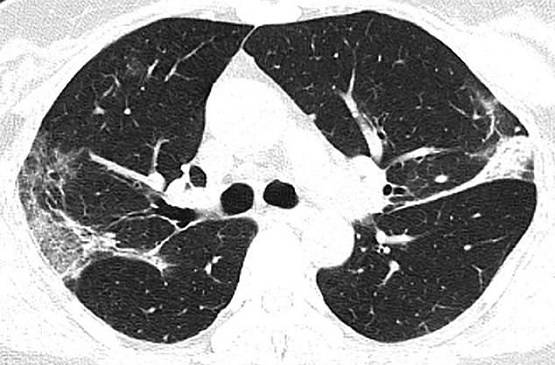 कोरोना वायरस से मरने वालों का क्या हुआ था हाल, देख लें ये रिपोर्ट्स