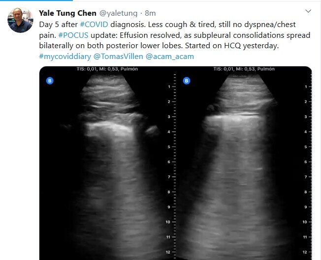 कोरोना मरीज की आपबीती, बताया कैसे शरीर में हमला करता है वायरस