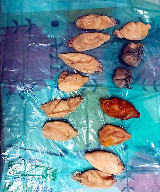 13 कंडोम में भरकर गुप्तांग में छुपा रखी थी कोकेन, तस्कर गिरफ्तार