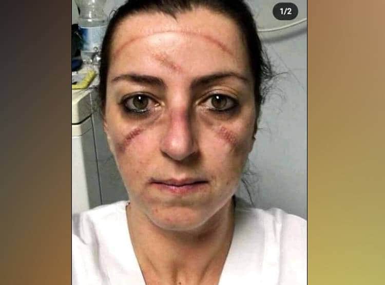 चेहरे पर लगे मास्क हटे तो रह गए निशान, PAK सांसद ने शेयर किए फोटो