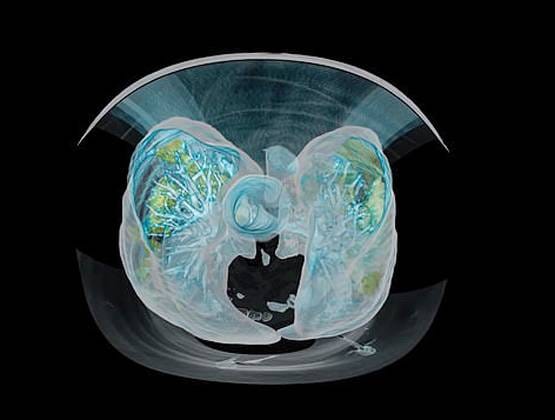 कुछ ही दिनों में फेफड़ों को कैसे बर्बाद कर देता है कोरोना, देखें तस्वीरें