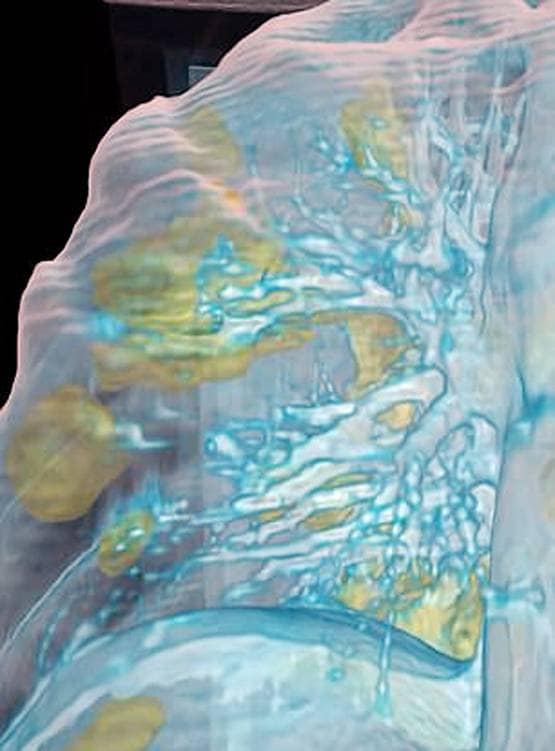 कुछ ही दिनों में फेफड़ों को कैसे बर्बाद कर देता है कोरोना, देखें तस्वीरें