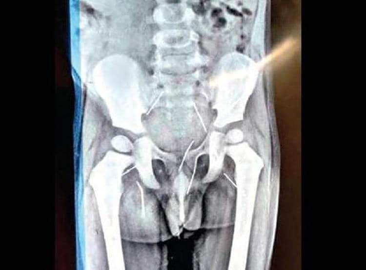 दर्द से तड़प रहा था बच्चा, X Ray देख चौंके डॉक्टर, गुप्तांग से निकलीं 11 सुइयां
