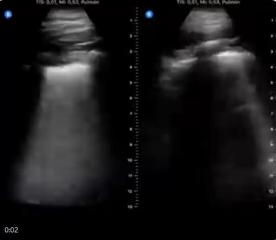 कोरोना मरीज की आपबीती, बताया कैसे शरीर में हमला करता है वायरस