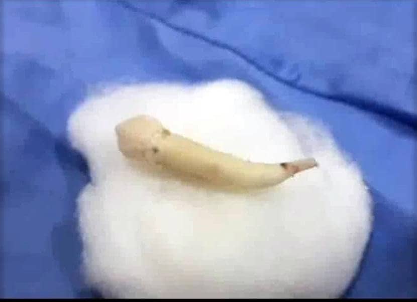 छात्र के मुंह से निकला दुनिया का सबसे लंबा दांत, डेंटिस्ट भी चौंक गए!