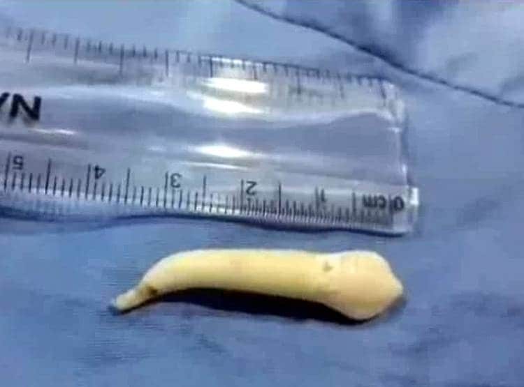 छात्र के मुंह से निकला दुनिया का सबसे लंबा दांत, डेंटिस्ट भी चौंक गए!