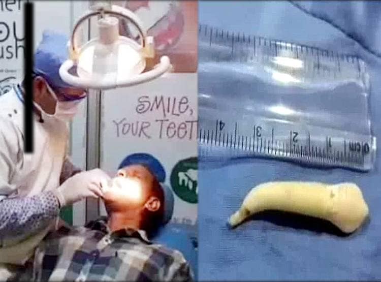 छात्र के मुंह से निकला दुनिया का सबसे लंबा दांत, डेंटिस्ट भी चौंक गए!