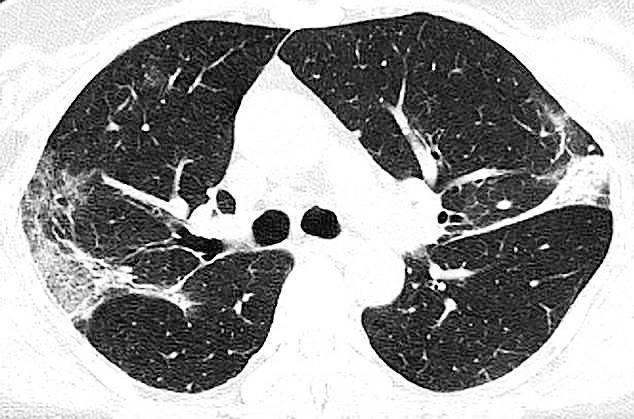 कोरोना मरीज के फेफड़े खराब कर देता है कोरोना, भर जाता है बलगम