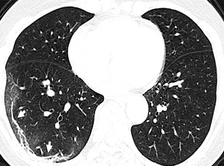 कोरोना मरीज के फेफड़े खराब कर देता है कोरोना, भर जाता है बलगम