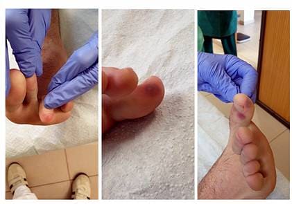 कोरोनाः डॉक्टरों ने खोजा नया लक्षण, पैरों पर दिख रहे हैं घाव