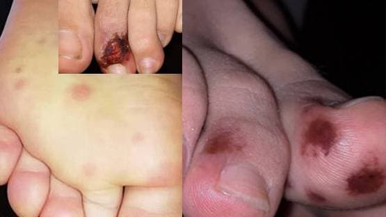 क्या पैरों पर ऐसे घाव हैं कोरोना के संकेत? जानें- डॉक्टर क्या बोले