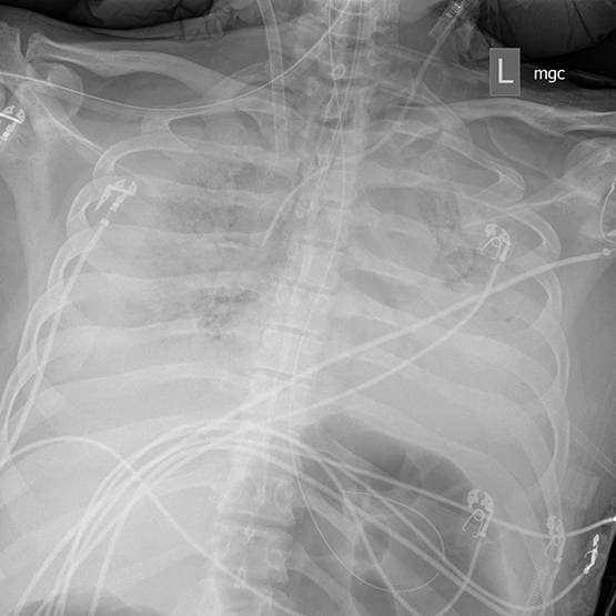 कोरोना: वेंटिलेटर पर था पति, 3 घंटे पत्नी से मुलाकात, फिर चमत्कार