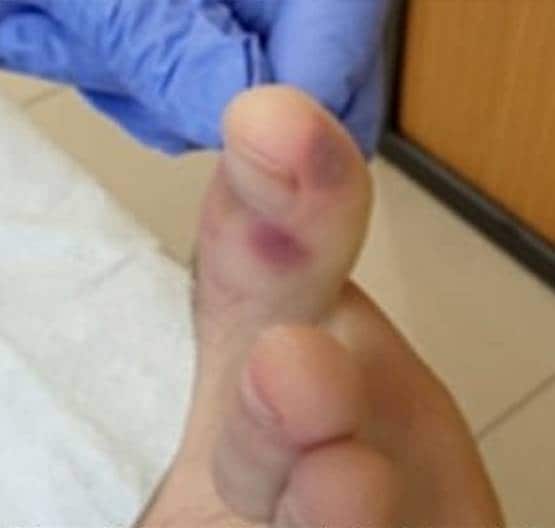 क्या पैरों पर ऐसे घाव हैं कोरोना के संकेत? जानें- डॉक्टर क्या बोले