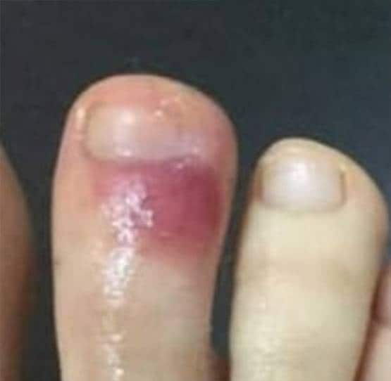 क्या पैरों पर ऐसे घाव हैं कोरोना के संकेत? जानें- डॉक्टर क्या बोले