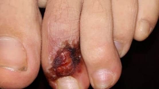 क्या पैरों पर ऐसे घाव हैं कोरोना के संकेत? जानें- डॉक्टर क्या बोले