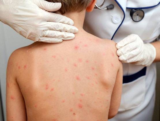 भारत आई कोरोना से जुड़ी बच्चों की दुर्लभ बीमारी, ये लक्षण न करें इग्नोर!