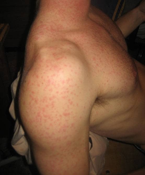 स्किन पर भी पड़ रहा कोरोना का बुरा असर, शरीर पर दिखे ऐसे धब्बे!