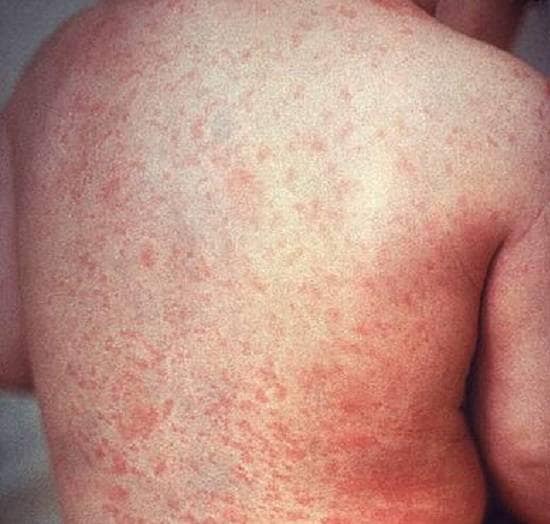 स्किन पर भी पड़ रहा कोरोना का बुरा असर, शरीर पर दिखे ऐसे धब्बे!