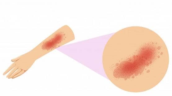 स्किन पर भी पड़ रहा कोरोना का बुरा असर, शरीर पर दिखे ऐसे धब्बे!